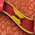 چربی خون بالا موجب استئوپروز می شود