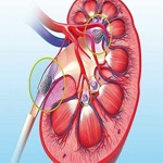 رژیم غذایی، فعالیت ورزشی و خطر بروز سنگ کلیه