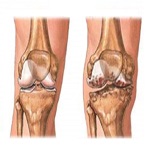 اثر مفید فعالیت ورزشی در مبتلایان به استئوآرتریت