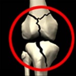 کمبود ویتامین 12B و افزایش خطر شکستگی در سالمندان