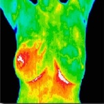 مقادیر زیاد اسید فولیک و خطر سرطان پستان