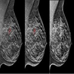 سرطان پستان: دویدن بهتر از راه رفت است