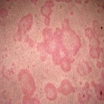 اثر ویتامین D بر بروز کهیر های مزمن