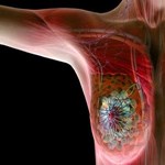 ویتامین D و بقای بیماران مبتلا به سرطان پستان