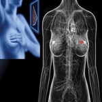 رابطه رژیم غذایی پرچربی با برخی از انواع سرطان پستان