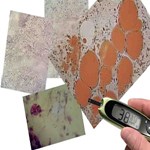 چربی قهوه ای و محافظت از ابتلا به دیابت