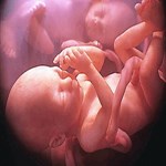 اثر چربی شیر انسان در رشد نوزادان نارس