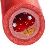 عدم پاسخ درمانی به داروهای کاهنده کلسترول با گرفتگی عروق رابطه دارد