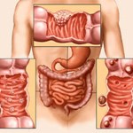 خطر ابتلا به سرطان کولون در عرض دو هفته!