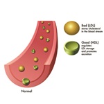 سطوح بسیار بالای کلسترول خوب (HDL) خطرناک است!