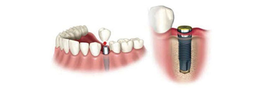 ایمپلنت دندانی چیست؟