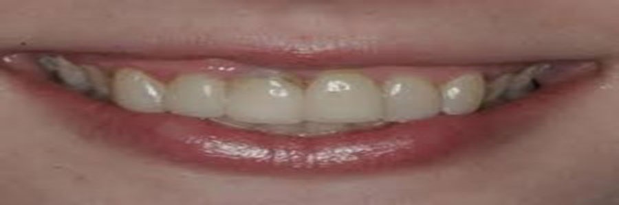 لمینیت های دندان