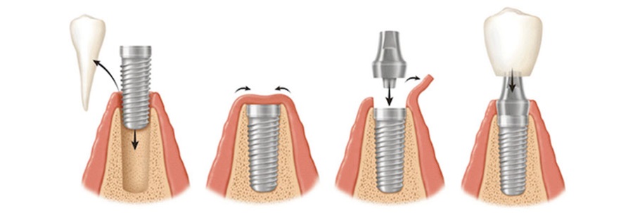 نقش ایمپلنت در ارتودنسی