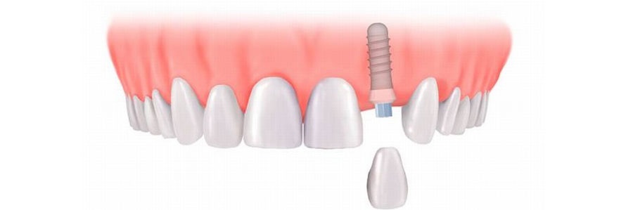 ایمپلنتهای دندانی