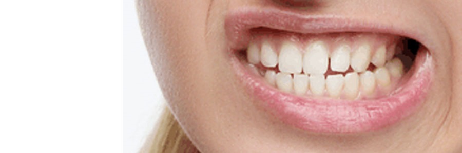 دندان قروچه یا سائیدن دندانها