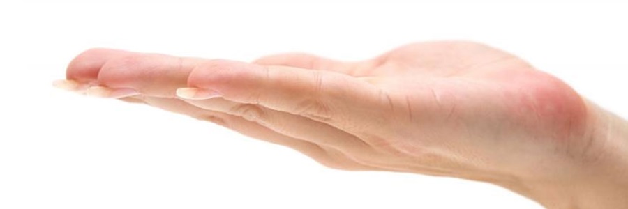 تعریق شدید کف دست (Hyperhidrosis)