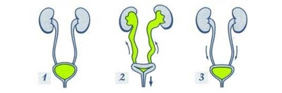 چرا شناسائی برگشت ادراری یا ریفلاکس وزیکویورترال در شیر خواران و کودکان از اهمیت ویژه ای برخوردار است؟