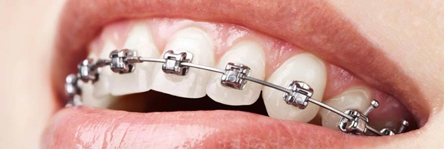 ارتودنسی و مشکل نامنظم بودن دندان ها
