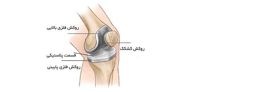 آرتروپلاستی مفصل ران