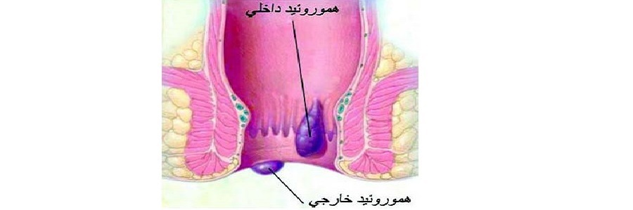 درمان بیماریهای مقعد(مخرج)-همورئید-شقاق-فیستول-کیست مویی