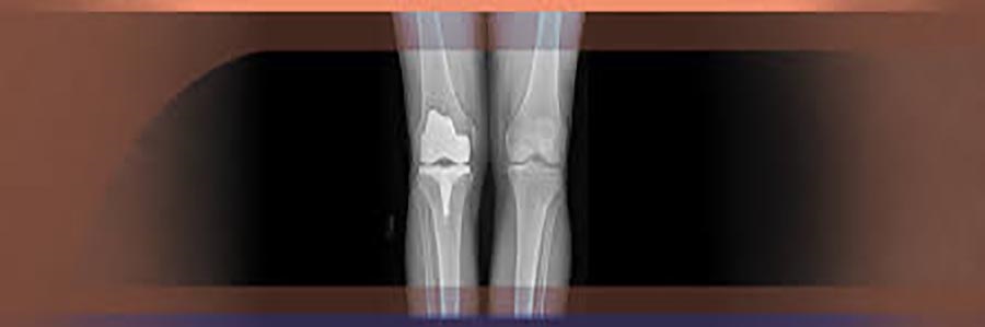 انواع آرتریت