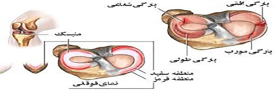 پارگی مینیسک زانو