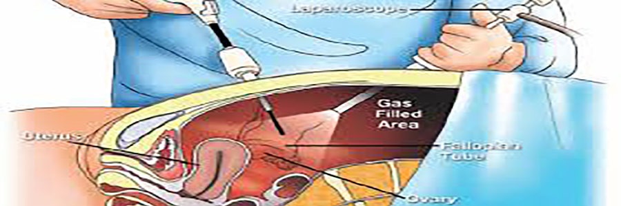 Laparoscopic management of ureteropelvic junction obstruction by division of anterior crossing vein and cephalad relocation of anterior crossing arter