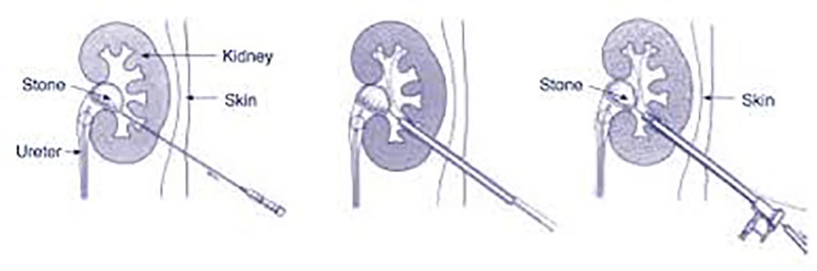 Experience of percutaneous nephrolithotomy using adult-size instruments in children less than 5 years old.