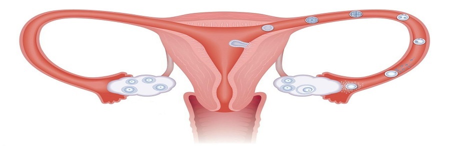 بیماری تخمدان های پر از کیست یا PCOD چیست؟