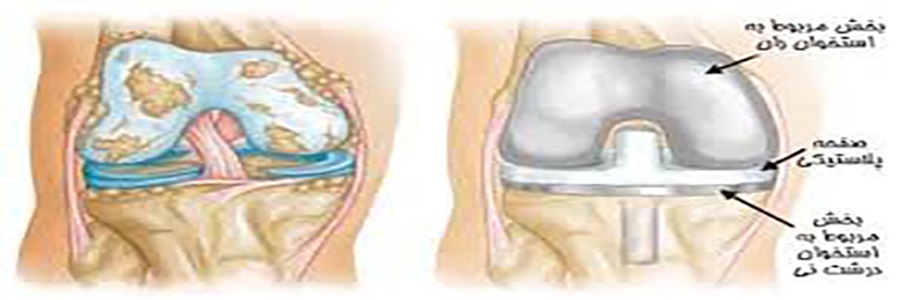 پرسش های مهم در خصوص تعویض مفصل زانو