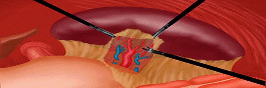 عمل جراحی برداشتن طحال با لاپاراسکوپ