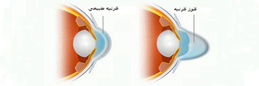 قوز قرنیه