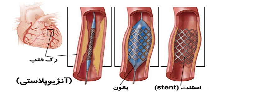 آنژیوگرافی