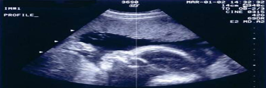 سونوگرافی در حاملگی