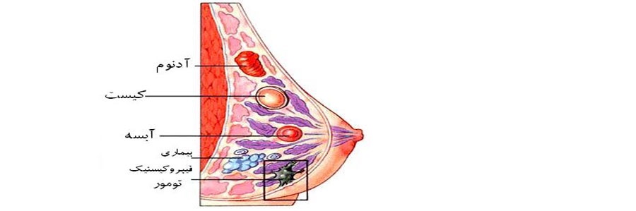 سرطان پستان  همه‌گیری شناسی