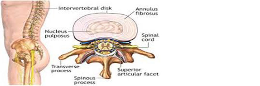 درمان فتق دیسک بین مهره ای