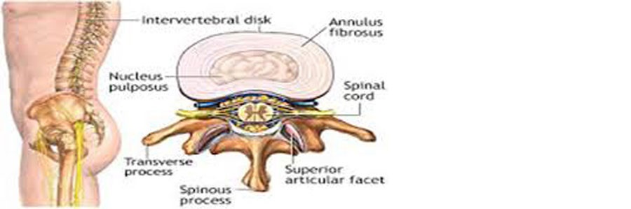 درمان فتق دیسک بین مهره ای
