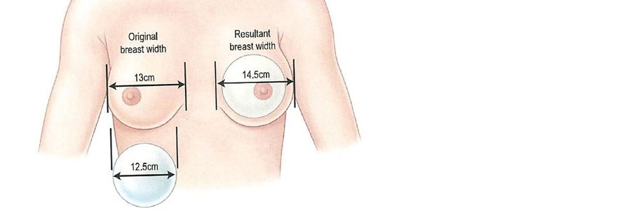 بزرگ کردن سینه