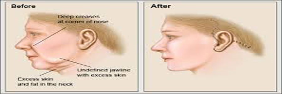 لیفت صورت و گردن