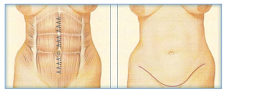 آبدومینوپلاستی (Abdominoplasty)