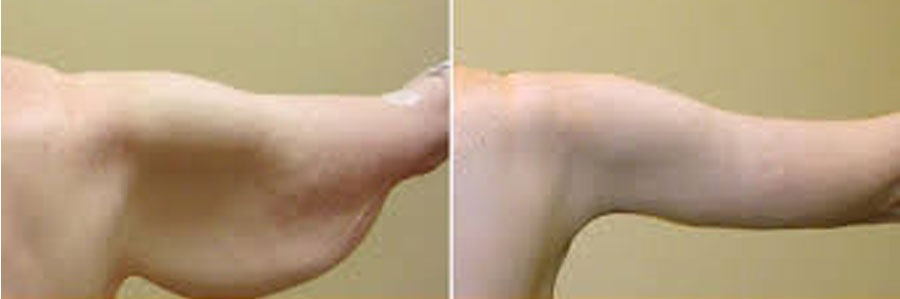 جراحی زیبایی بازو (Brachioplasty)