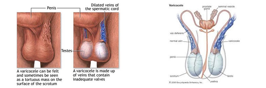 درباره واریکوسل