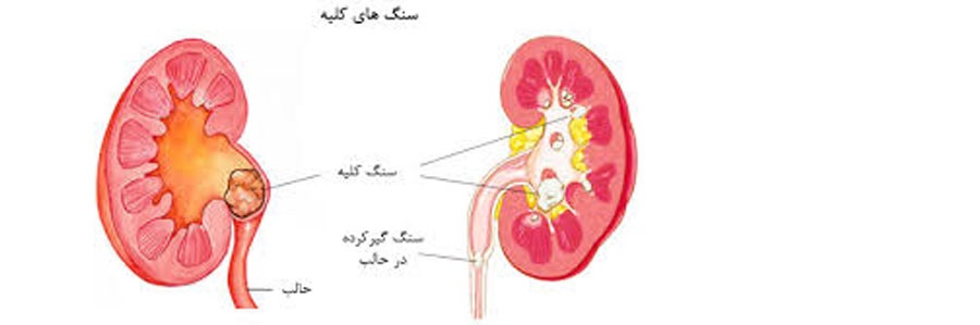 درمان سنگ های کلیه