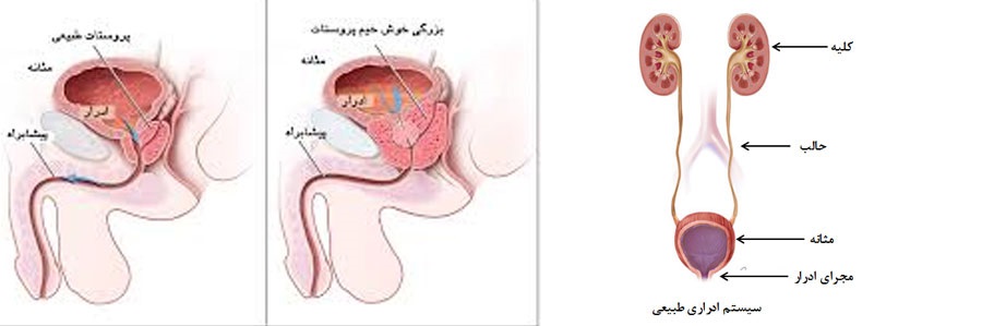 علایم مجرای ادراری تحتانی در مردان