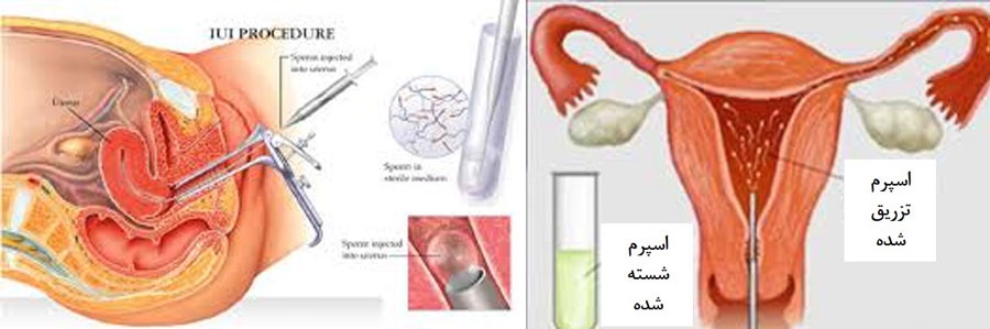 IUI چیست؟