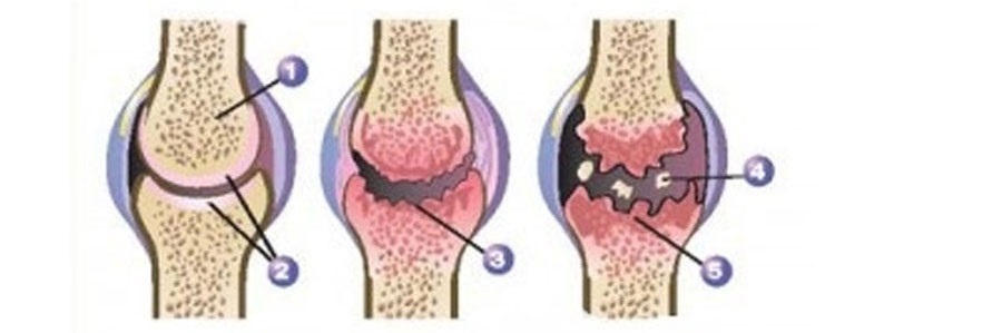 آرتروز چیست ؟