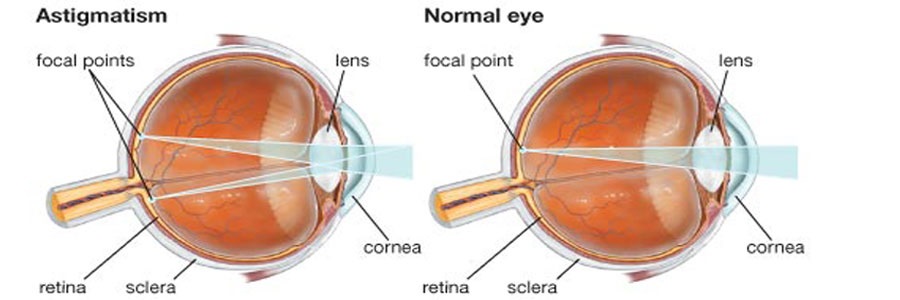 بیماری  : آستیگماتیسم