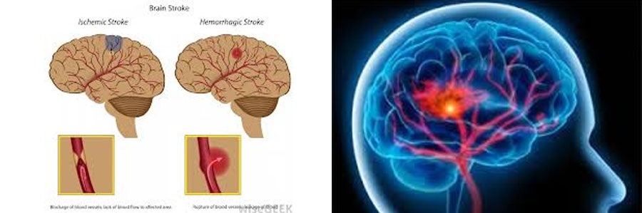 سکته مغزی