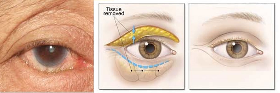 برگشتگی پلک به داخل (جراحی پلک)
