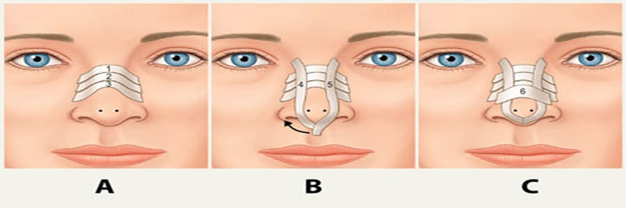 دستورات قبل و بعد از عمل جراحی بینی